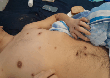 Red Positiva critica falta de vacunas contra viruela símica